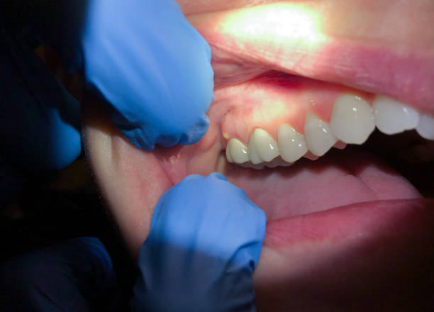 Best Emergency Wisdom Tooth Extraction in Lufkin, TX