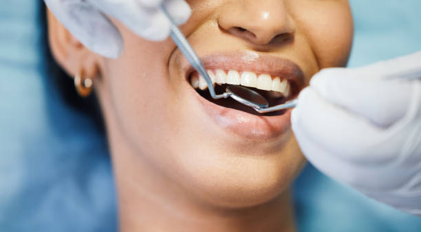 Best Emergency Wisdom Tooth Extraction in Lufkin, TX