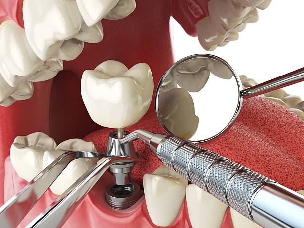 Best Broken or Chipped Tooth Repair in Lufkin, TX